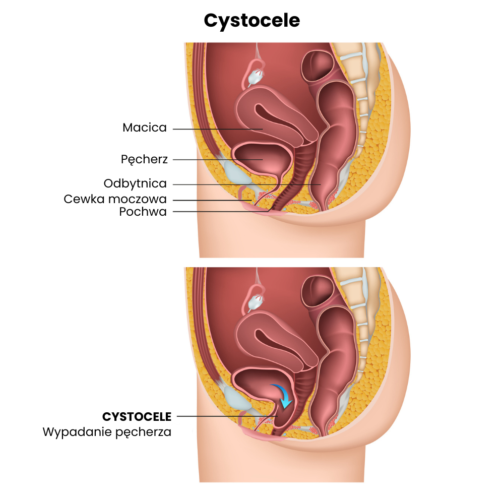 cystocele