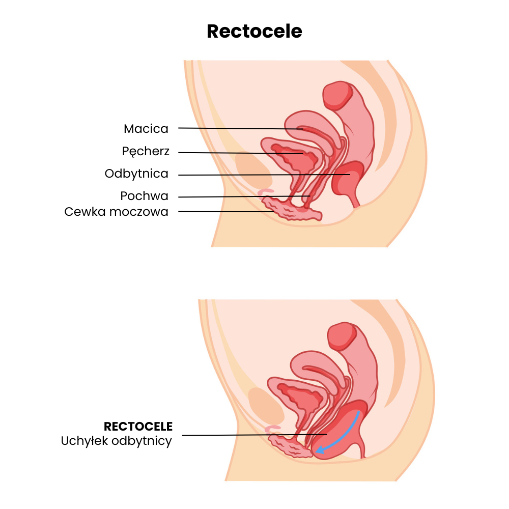 rectocele