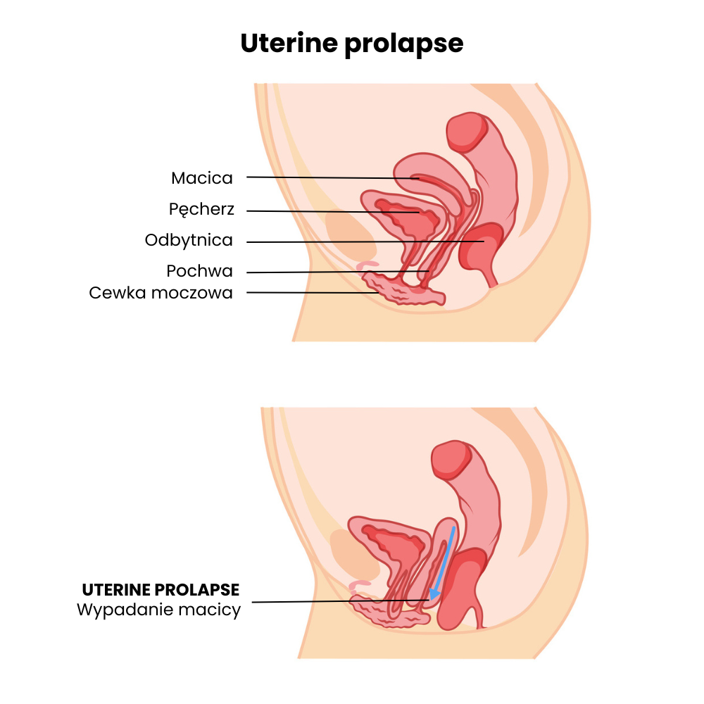 wypadanie macicy