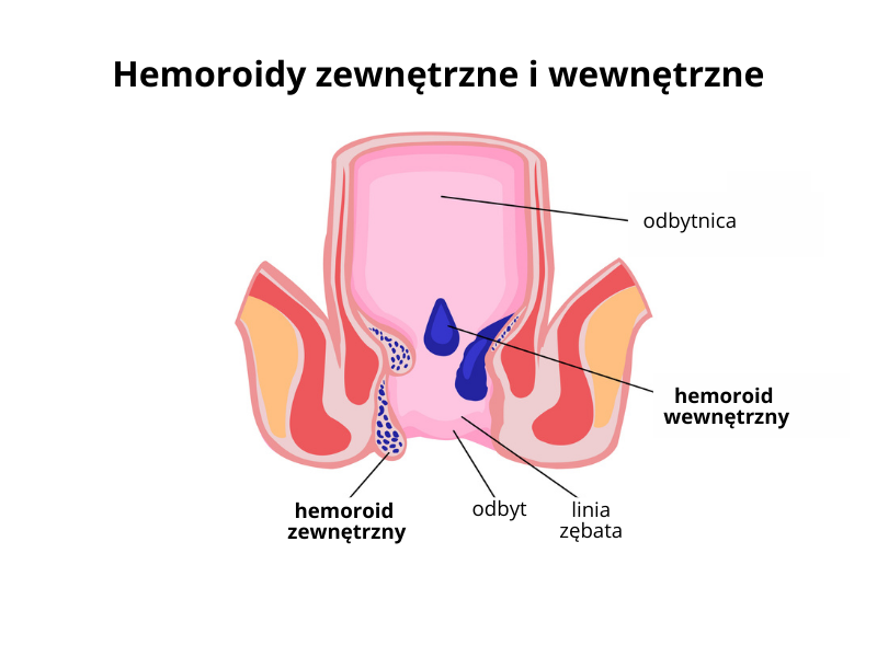 hemoroidy