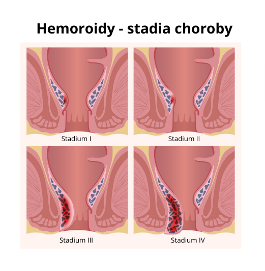 hemoroidy stadia choroby