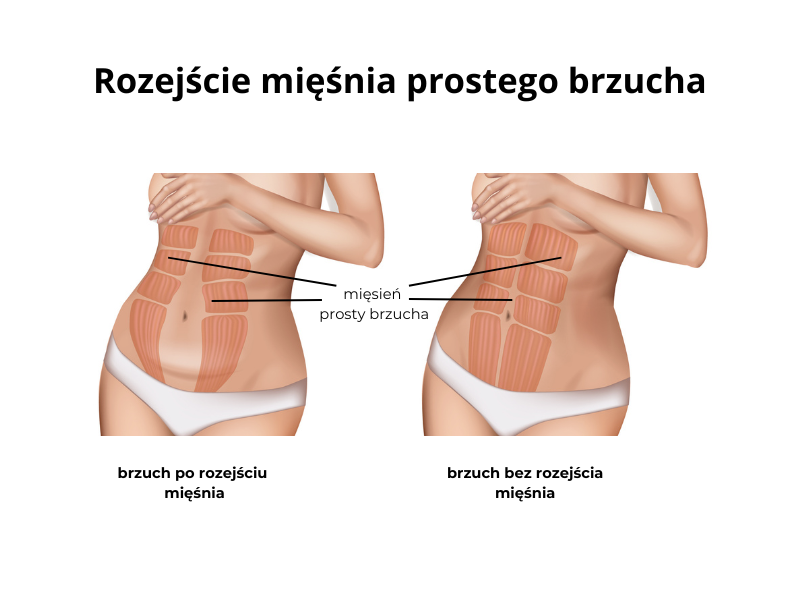 rozstęp mięśnia prostego brzucha