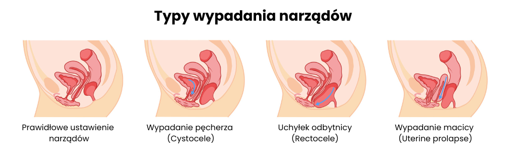 wypadanie narządów rodnych rodzaje