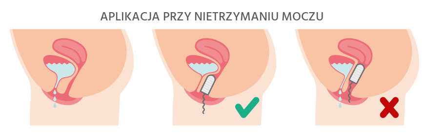 Contam Normal Tampons Vaginal Pessary no.1 mini 1pc.