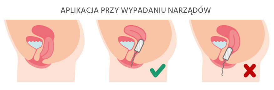 tampony na nietrzymanie moczu