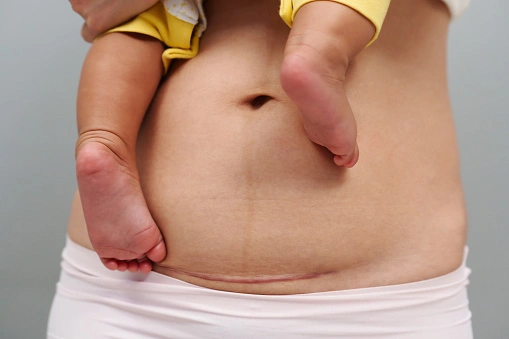 Blizna po cesarskim cięciu Rana po cesarskim cięciu