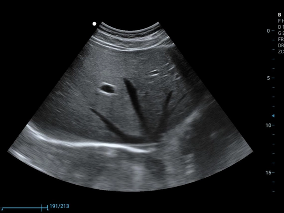 Mobilny aparat USG Zoncare M70 z głowicą liniową, convex i transwaginalną