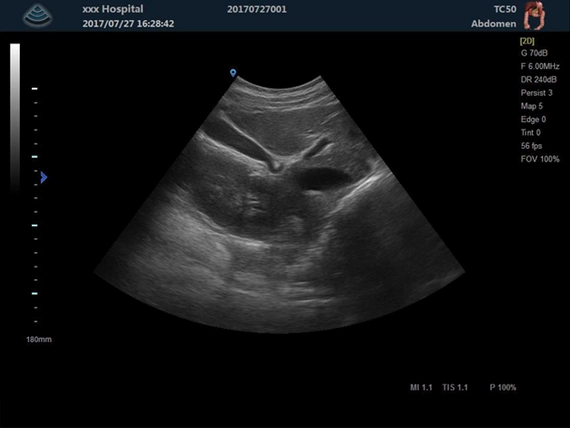 Ultrasound machine Zoncare M5 with a transvaginal head