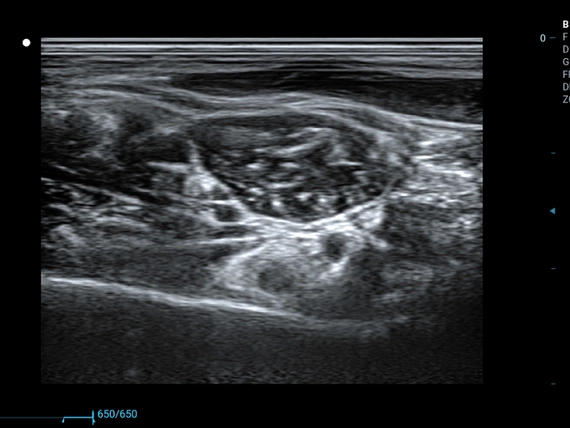 Mobilny aparat USG Zoncare M70 z głowicą liniową