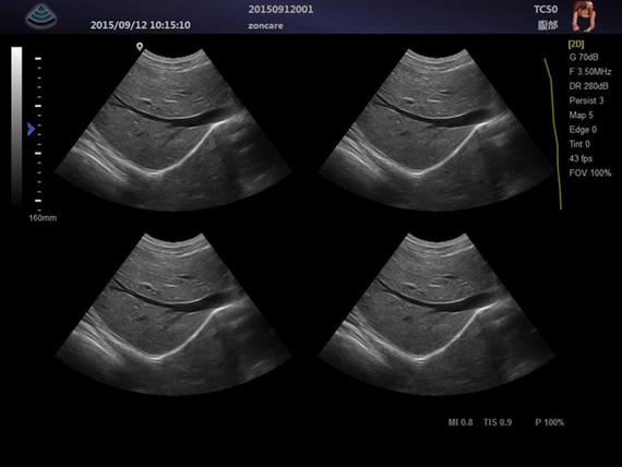 Ultrasound machine Zoncare M5 with a linear head