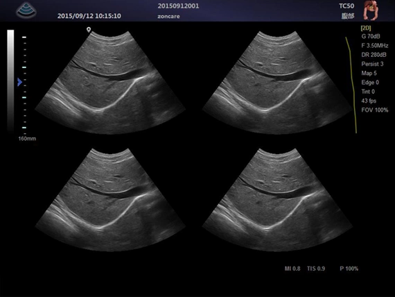 Ultrasound machine Zoncare M5 with a transvaginal head