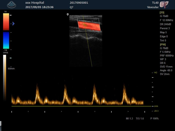 Ultrasound machine Zoncare M5 with a linear head