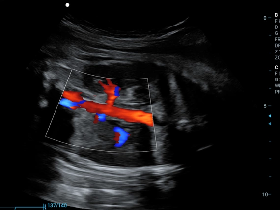 Mobilny aparat USG Zoncare M70 z głowicą liniową