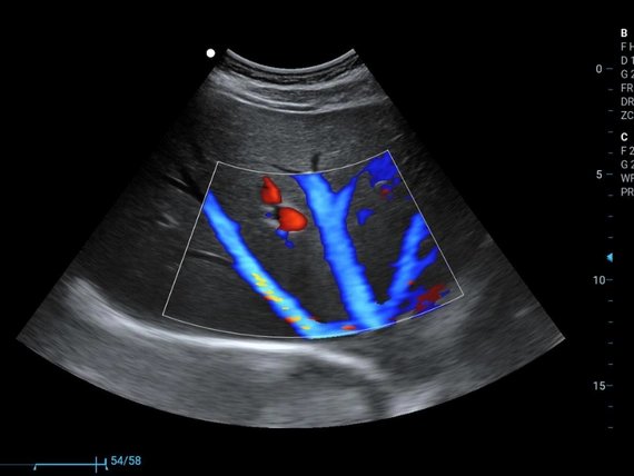 Mobilny aparat USG Zoncare M70 z głowicą liniową, convex i transwaginalną