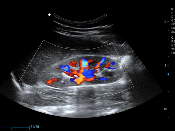 Mobilny aparat USG Zoncare M70 z głowicą liniową, convex i transwaginalną