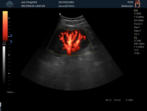 Ultrasound machine Zoncare M5 with a linear head