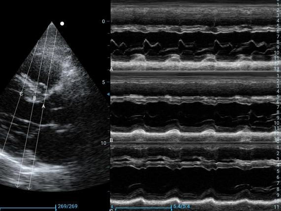 Mobilny aparat USG Zoncare M70 z głowicą liniową i convex